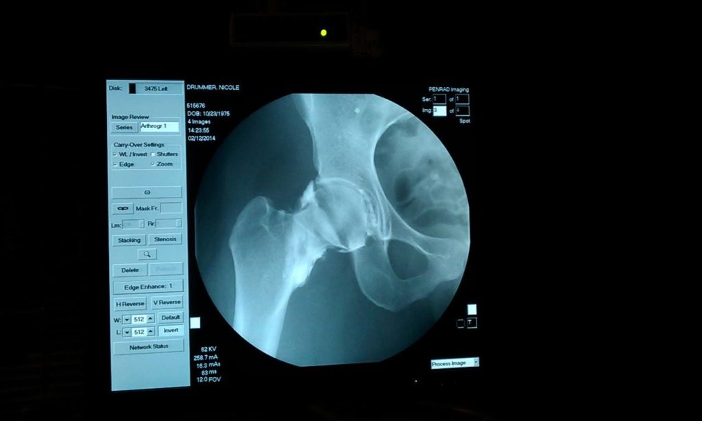 X-ray of Coach Nicole Odell’s hip just before an MRI (these are done with contrast so they inject a dye into the joint.)